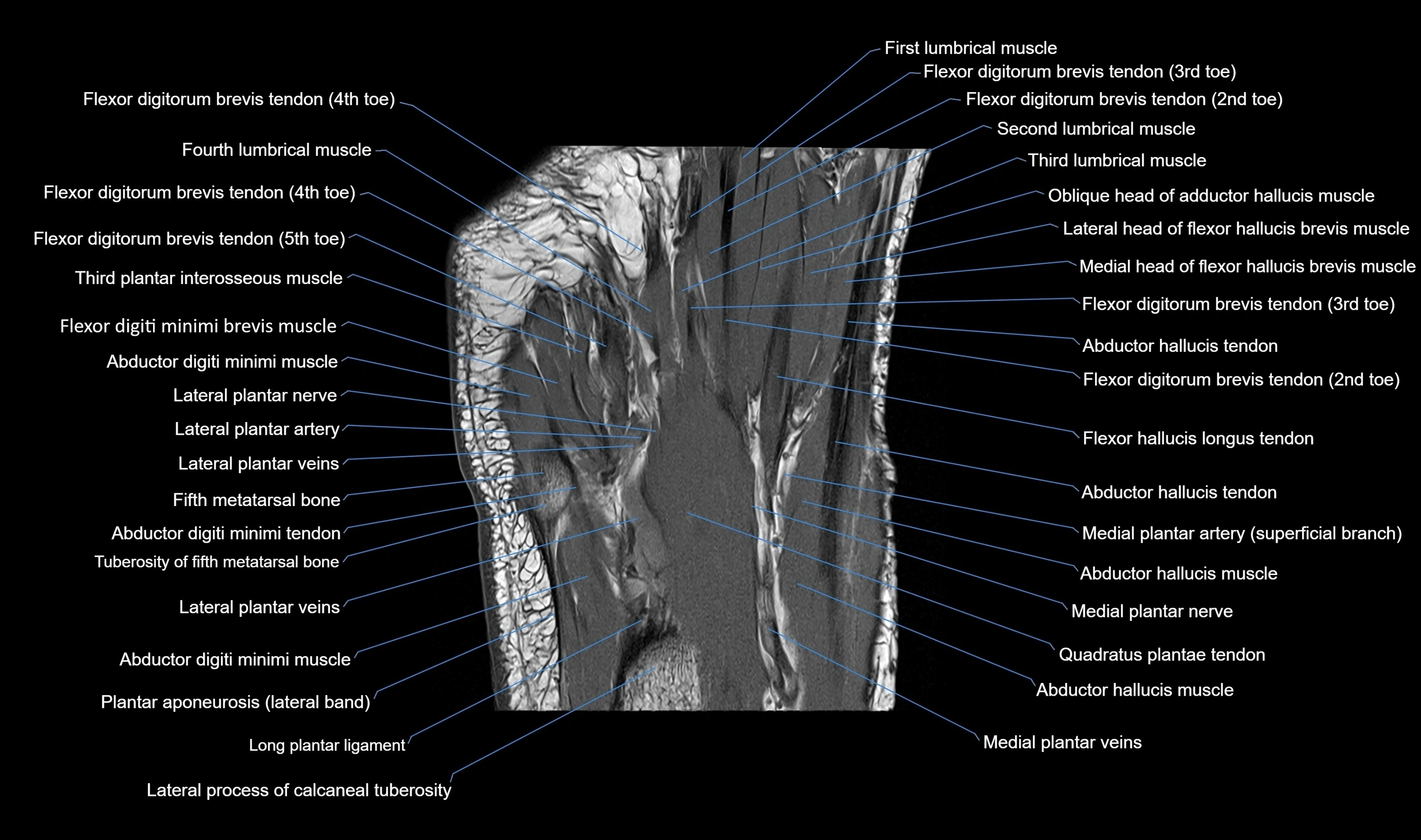 MRI mid foot coronal ligaments cross sectional anatomy 3T  radiology  image-img-00001-00032.webp